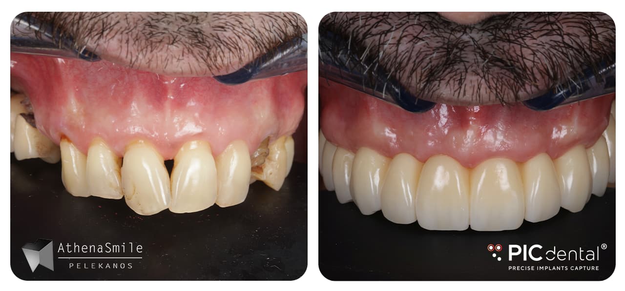 Rehabilitation of maxillary FP1 with advanced periodontitis, non